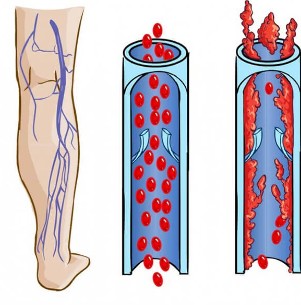 Ano ang hitsura ng isang normal na ugat at isang ugat na may mga varicose veins