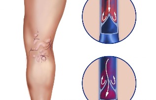 Mga komplikasyon ng varicose veins