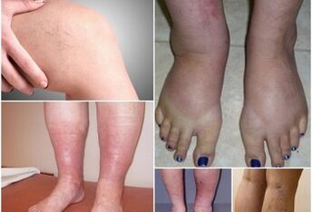 Mga larawan ng mga pagpapakita ng mga varicose veins sa mga binti