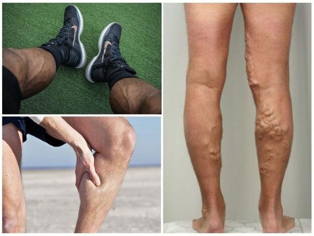 ano ang hitsura ng varicose veins sa mga binti ng lalaki