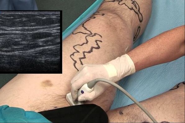 diagnosis ng varicose veins sa mga lalaki