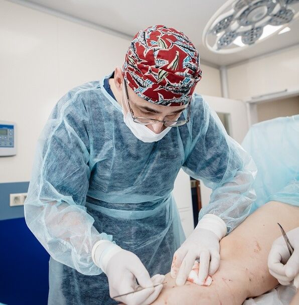 kirurhiko paggamot ng varicose veins