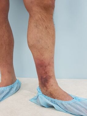 komplikasyon mula sa varicose veins sa mga lalaki
