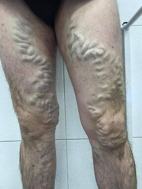 napabayaan ang mga male varicose veins