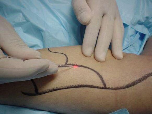 laser treatment ng varicose veins