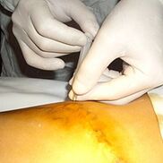 Ang Miniphlebectomy ay ang pinaka-cosmetic na paggamot para sa varicose veins