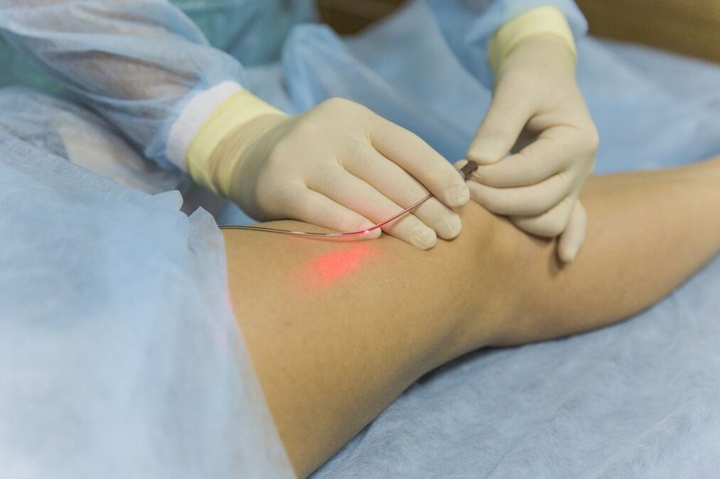 Laser treatment ng varicose veins ng lower extremities