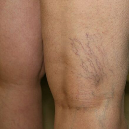 Ang venous mesh sa lower extremities ay tanda ng varicose veins