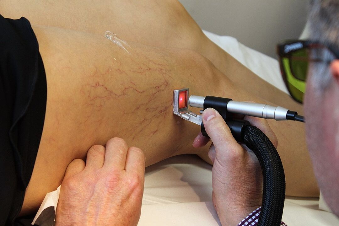 Laser coagulation