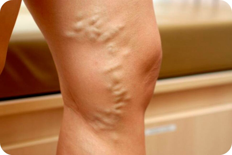Varicose veins ng mga ugat
