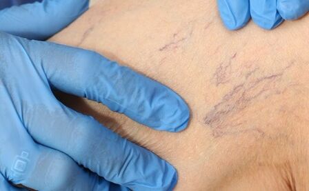 Mga sintomas ng varicose veins