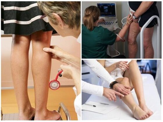 Diagnosis ng varicose veins