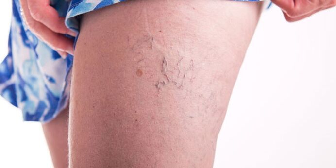 Pag -iwas sa mga varicose veins