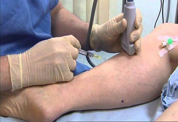 Paggamot ng mga varicose veins