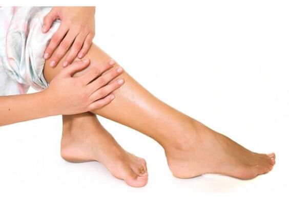 Varicose veins