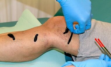 Hirudotherapy para sa mga varicose veins