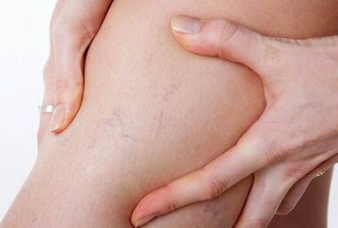 Ipinagbabawal na mga aksyon para sa mga varicose veins