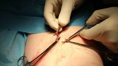 Flebectomy para sa mga varicose veins