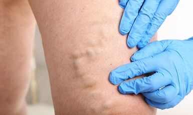 Varicose veins sa mga binti