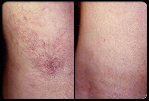Bago at pagkatapos ng sclerotherapy