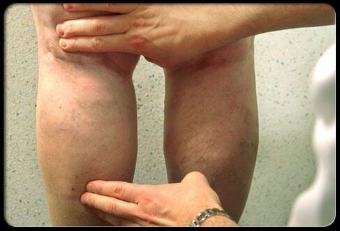 Sinusuri ng doktor ang mga binti na may mga varicose veins
