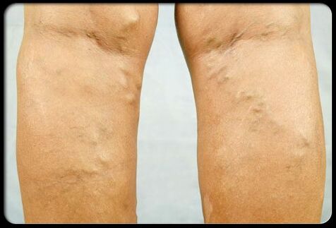 Varicose veins sa mga binti