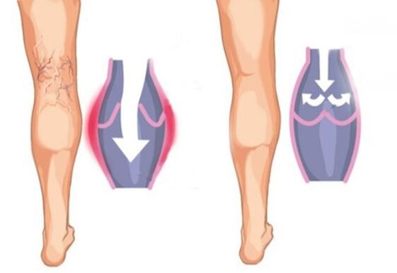 Ano ang hitsura ng mga varicose veins