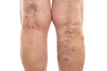 varicose veins ng lower extremities